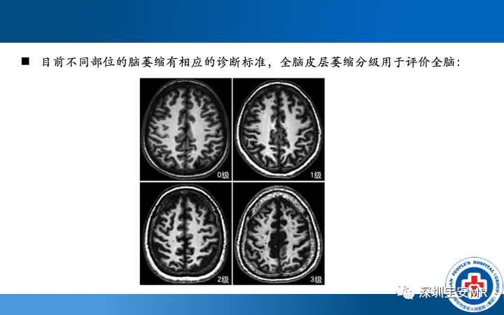 影像PPT - 【PPT】脑小血管病神经影像评估-35