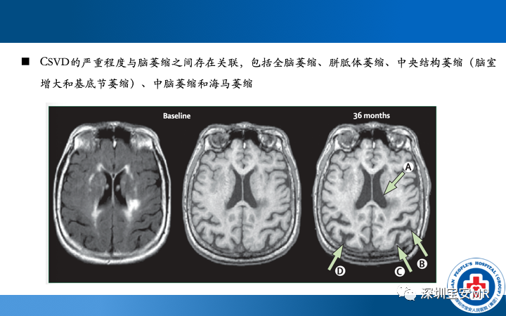 影像PPT - 【PPT】脑小血管病神经影像评估-36