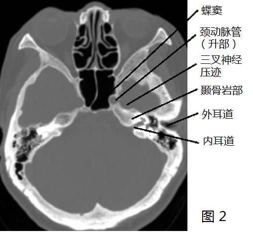 影像PPT - 颈内动脉走形:概述及颈段、岩段和破裂孔段-30 影像PPT - 颈内动脉走形:概述及颈段、岩段和破裂孔段-30