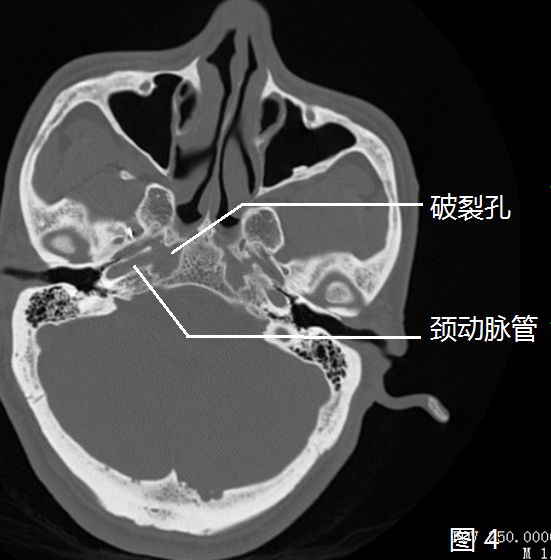 影像PPT - 颈内动脉走形:概述及颈段、岩段和破裂孔段-31 影像PPT - 颈内动脉走形:概述及颈段、岩段和破裂孔段-31