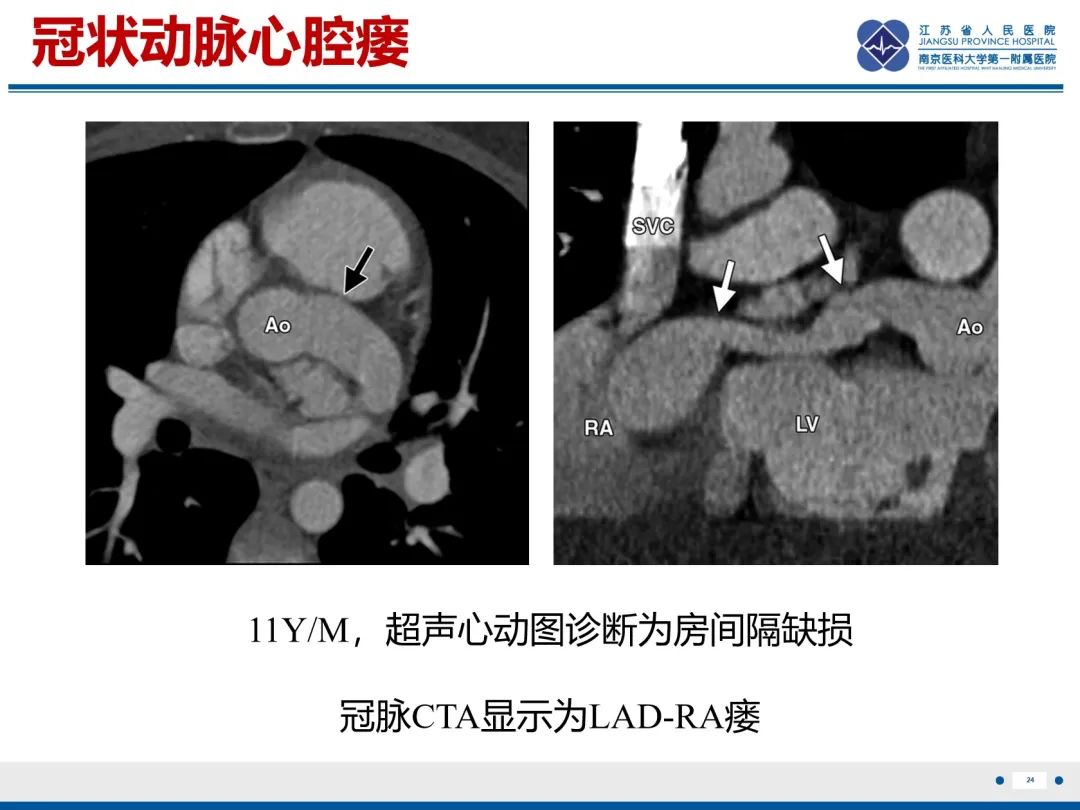 影像PPT - 【PPT】冠状动脉瘘-25