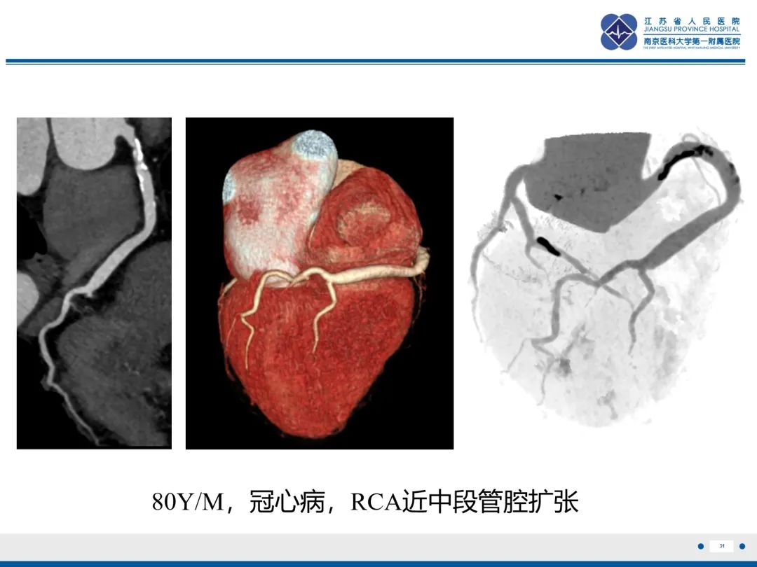 影像PPT - 【PPT】冠状动脉瘘-32