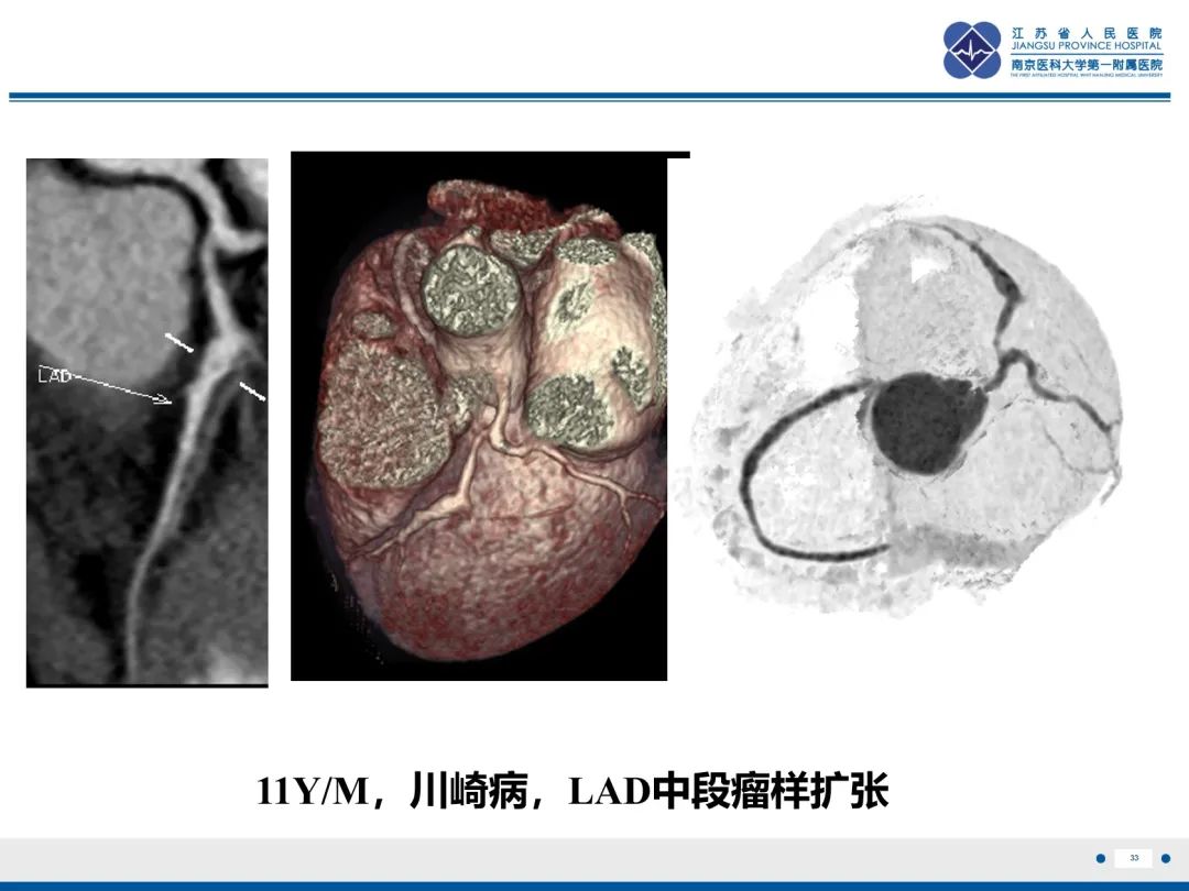 影像PPT - 【PPT】冠状动脉瘘-34