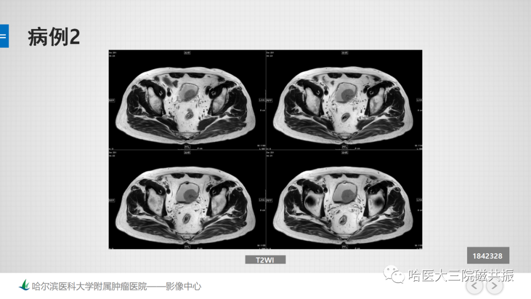 影像PPT - 【PPT】膀胱误诊病例及膀胱癌报告书写规范-13