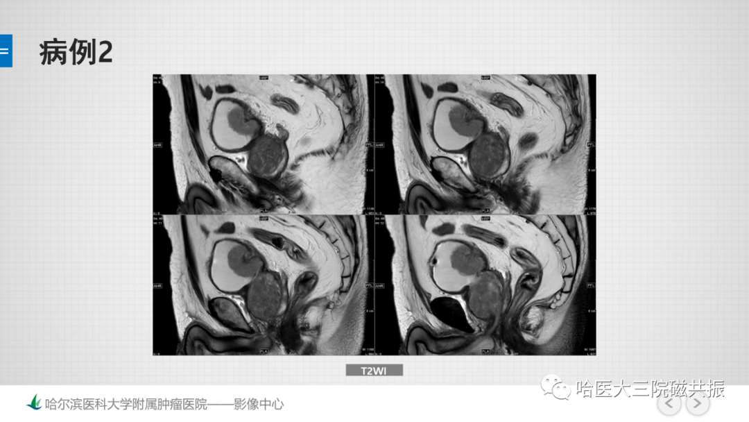 影像PPT - 【PPT】膀胱误诊病例及膀胱癌报告书写规范-14