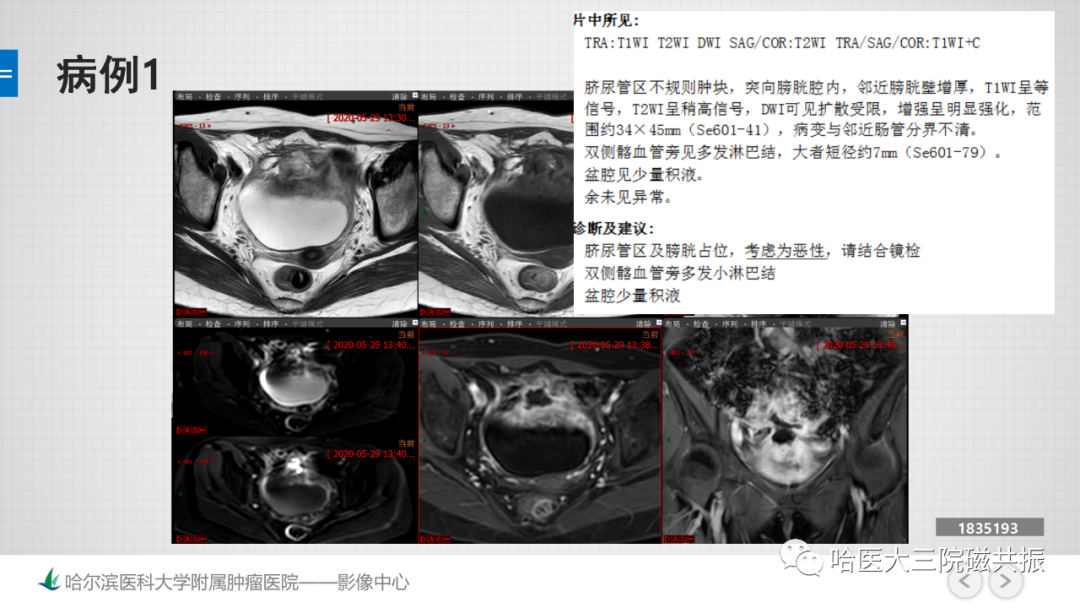 影像PPT - 【PPT】膀胱误诊病例及膀胱癌报告书写规范-3