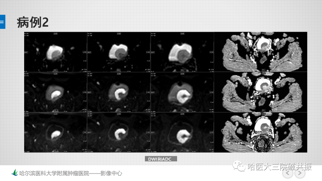 影像PPT - 【PPT】膀胱误诊病例及膀胱癌报告书写规范-6