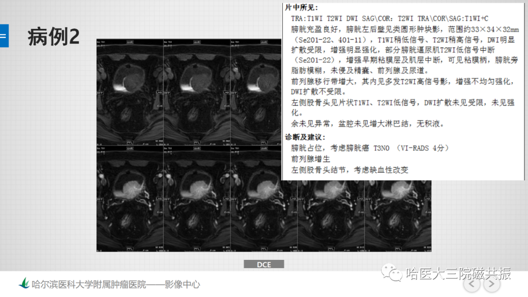 影像PPT - 【PPT】膀胱误诊病例及膀胱癌报告书写规范-7