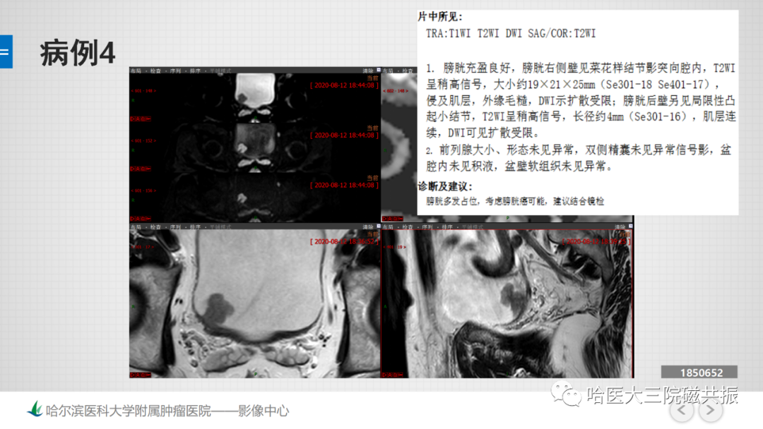 影像PPT - 【PPT】膀胱误诊病例及膀胱癌报告书写规范-11