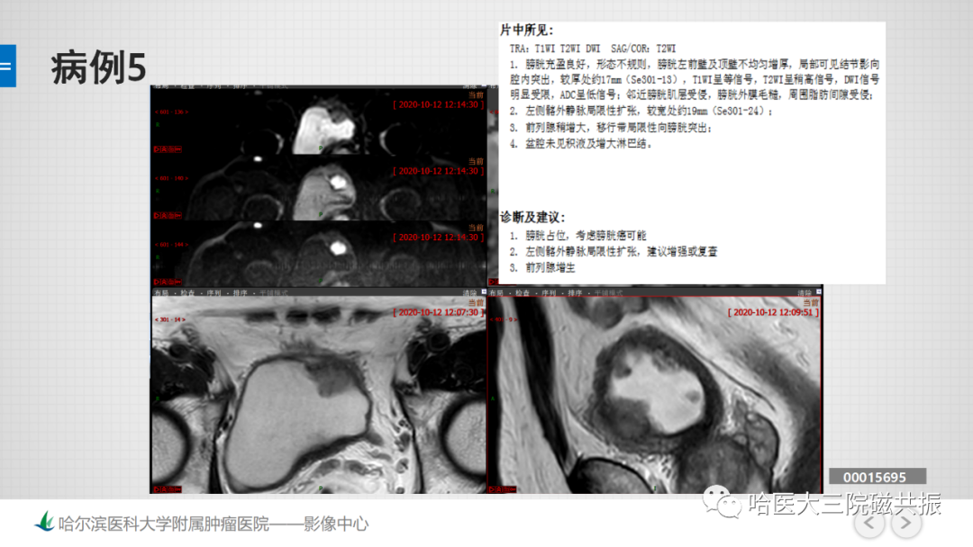 影像PPT - 【PPT】膀胱误诊病例及膀胱癌报告书写规范-14