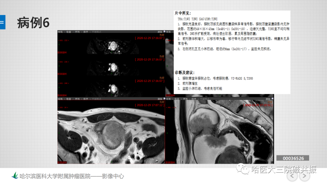 影像PPT - 【PPT】膀胱误诊病例及膀胱癌报告书写规范-17