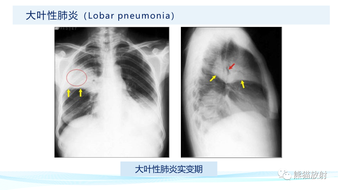 影像PPT - 【PPT】肺炎的常见影像学表现-13