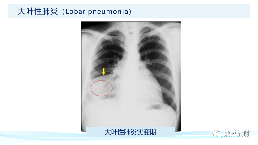 影像PPT - 【PPT】肺炎的常见影像学表现-14