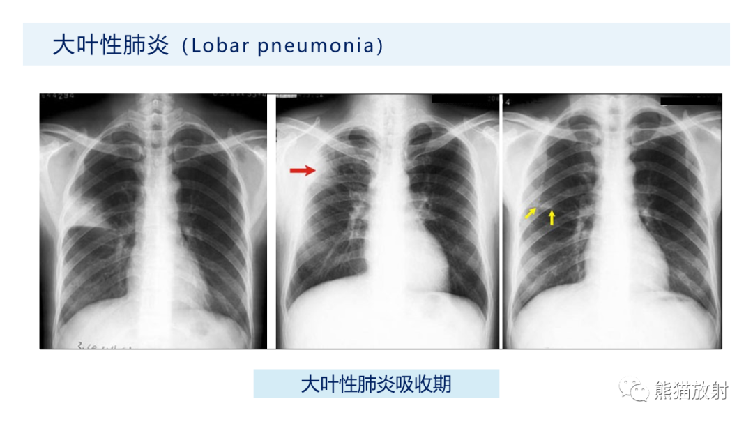 影像PPT - 【PPT】肺炎的常见影像学表现-15