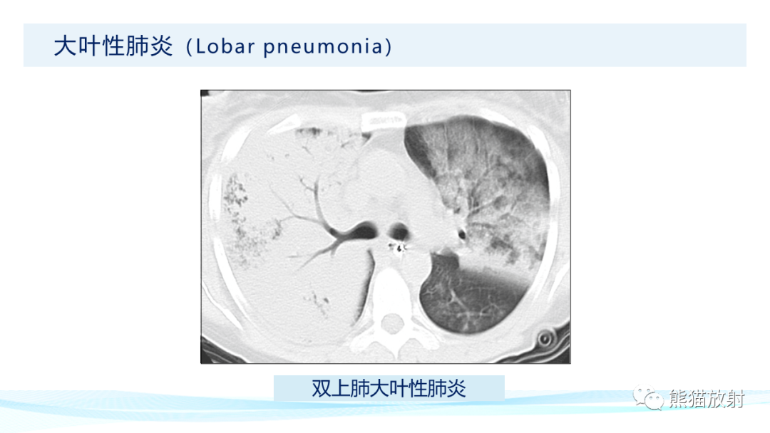 影像PPT - 【PPT】肺炎的常见影像学表现-16