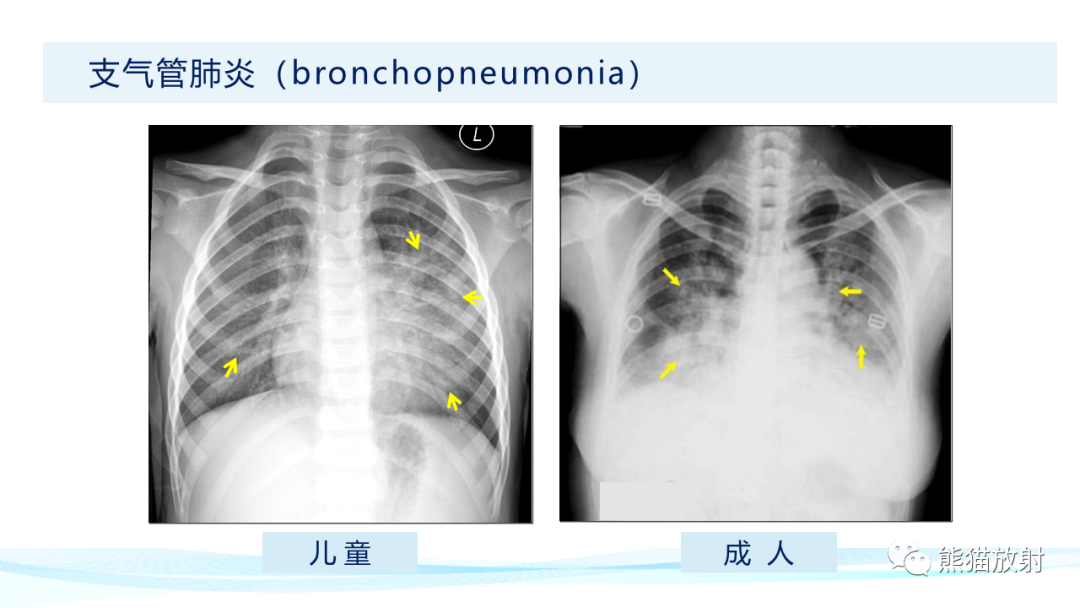 影像PPT - 【PPT】肺炎的常见影像学表现-20