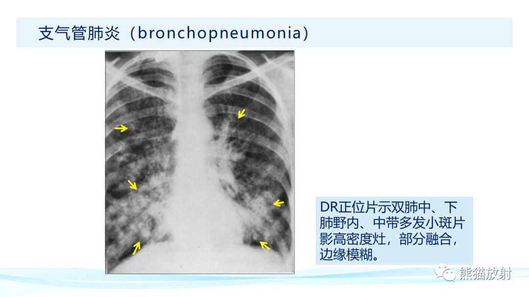 影像PPT - 【PPT】肺炎的常见影像学表现-21