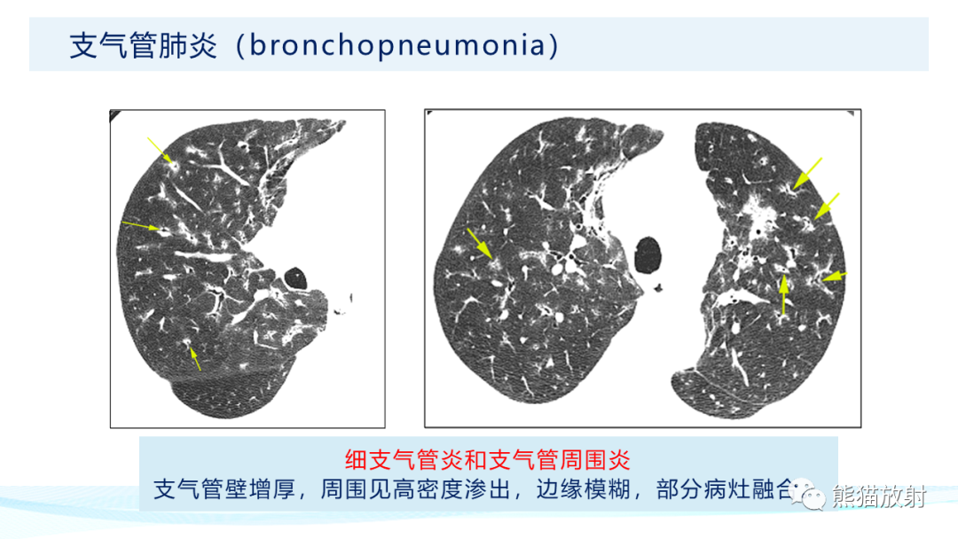 影像PPT - 【PPT】肺炎的常见影像学表现-22