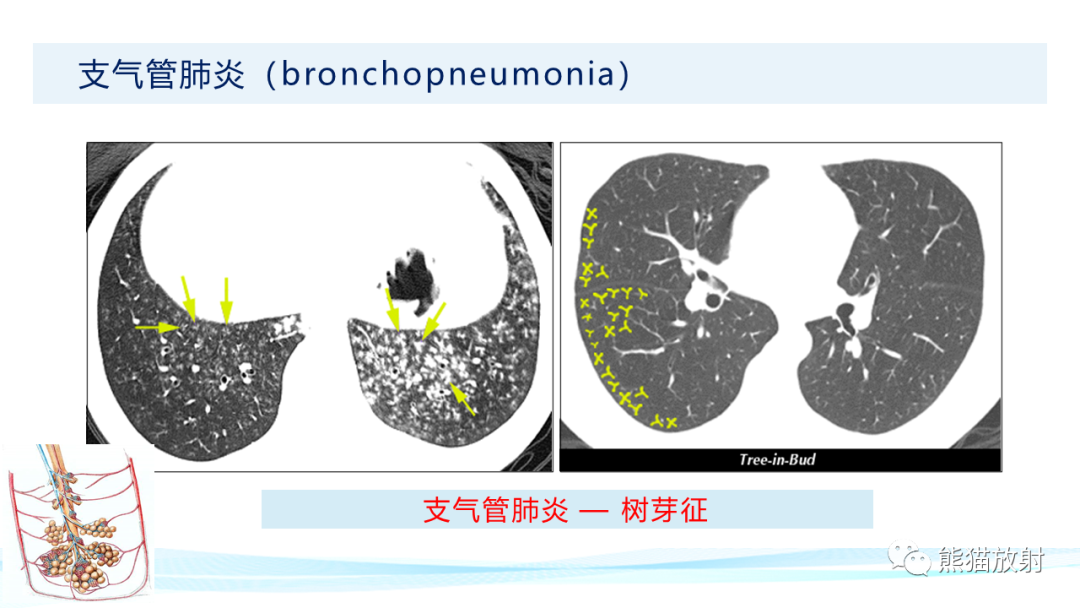 影像PPT - 【PPT】肺炎的常见影像学表现-23