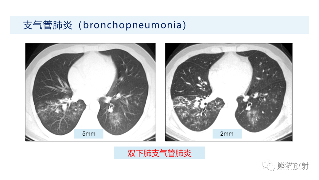 影像PPT - 【PPT】肺炎的常见影像学表现-24