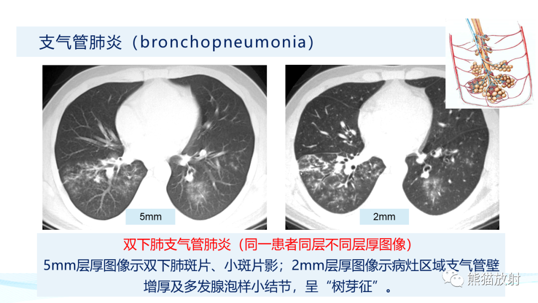 影像PPT - 【PPT】肺炎的常见影像学表现-25
