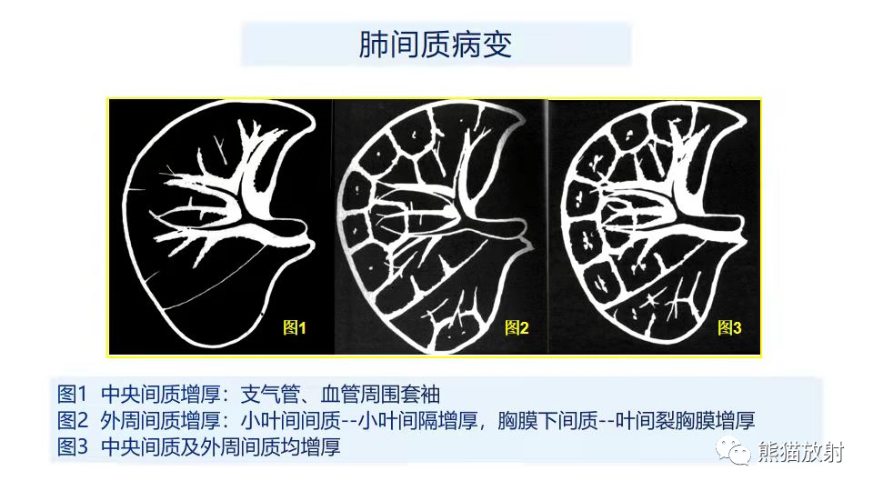 影像PPT - 【PPT】肺炎的常见影像学表现-28