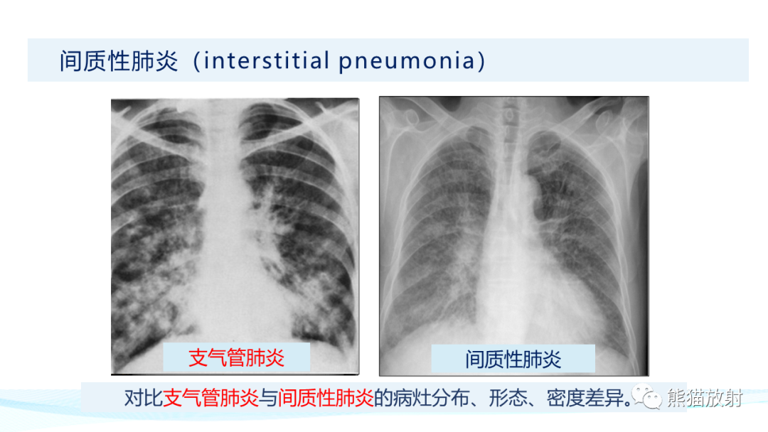 影像PPT - 【PPT】肺炎的常见影像学表现-31
