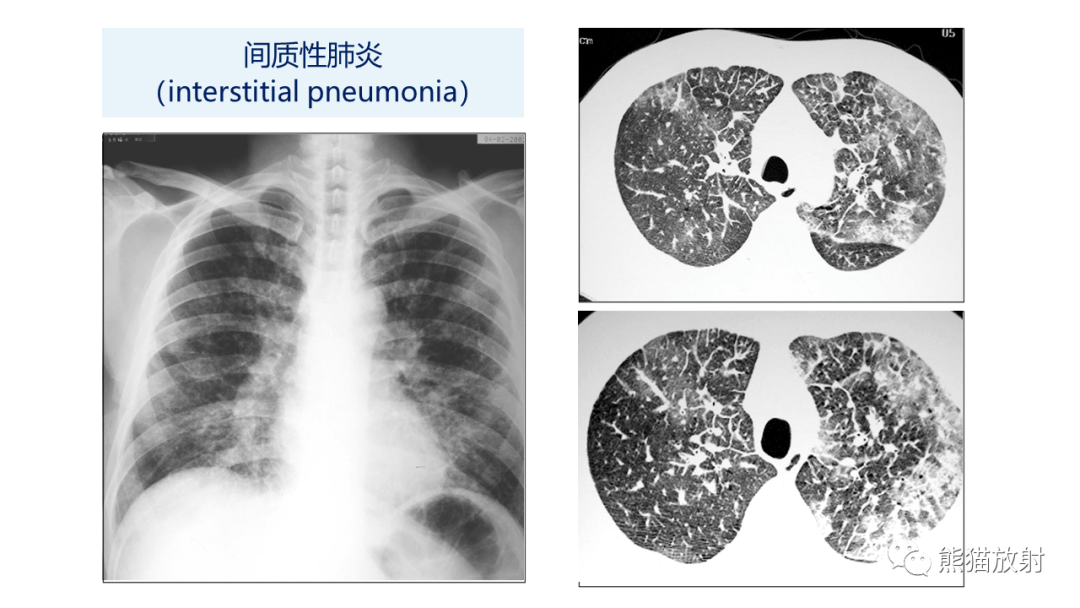 影像PPT - 【PPT】肺炎的常见影像学表现-33