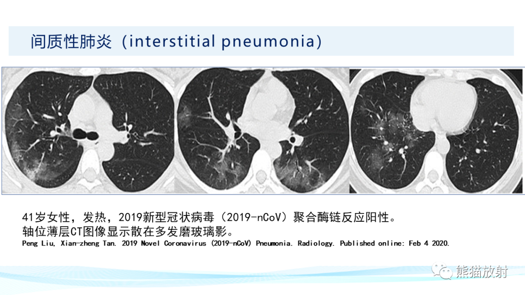 影像PPT - 【PPT】肺炎的常见影像学表现-35