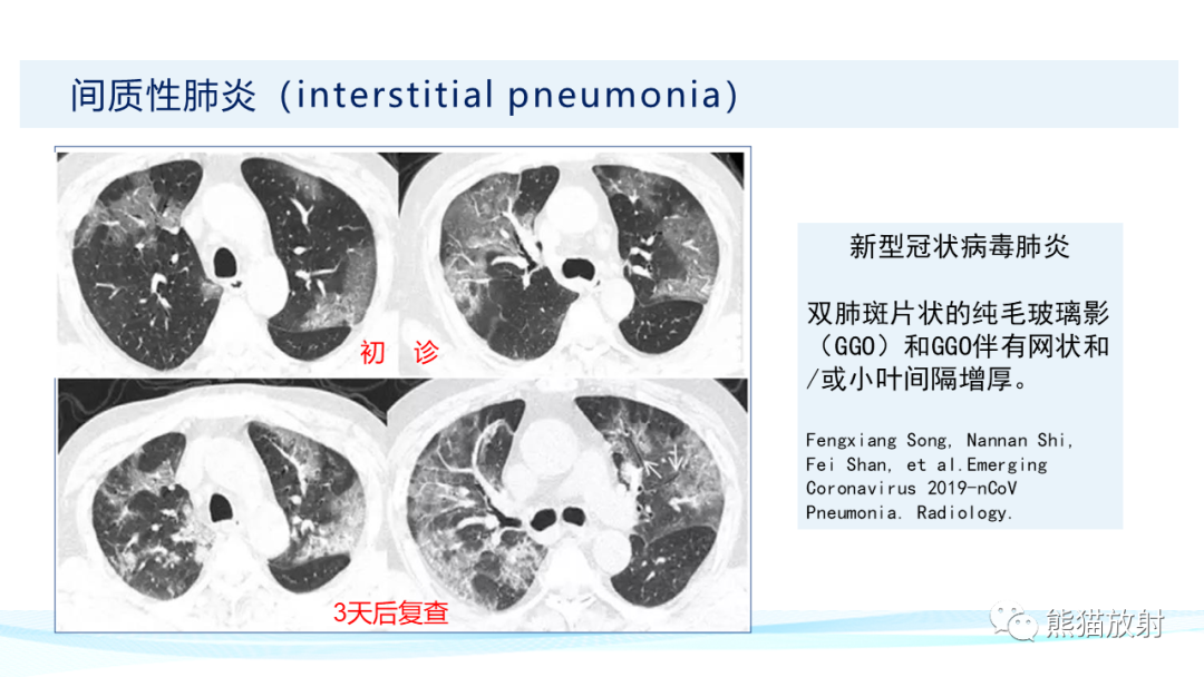 影像PPT - 【PPT】肺炎的常见影像学表现-36
