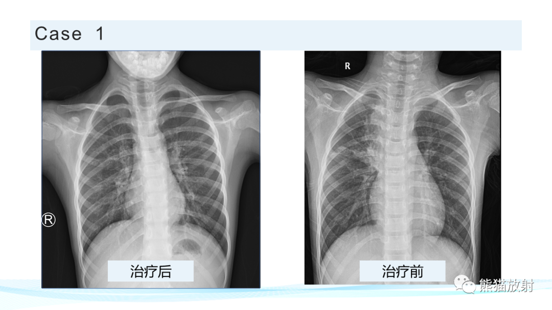 影像PPT - 【PPT】肺炎的常见影像学表现-43