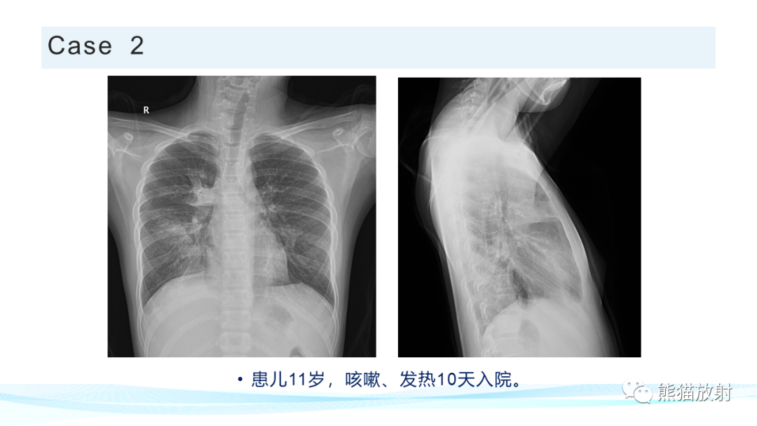 影像PPT - 【PPT】肺炎的常见影像学表现-45