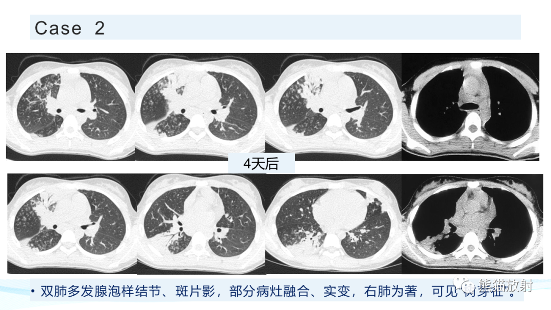 影像PPT - 【PPT】肺炎的常见影像学表现-48