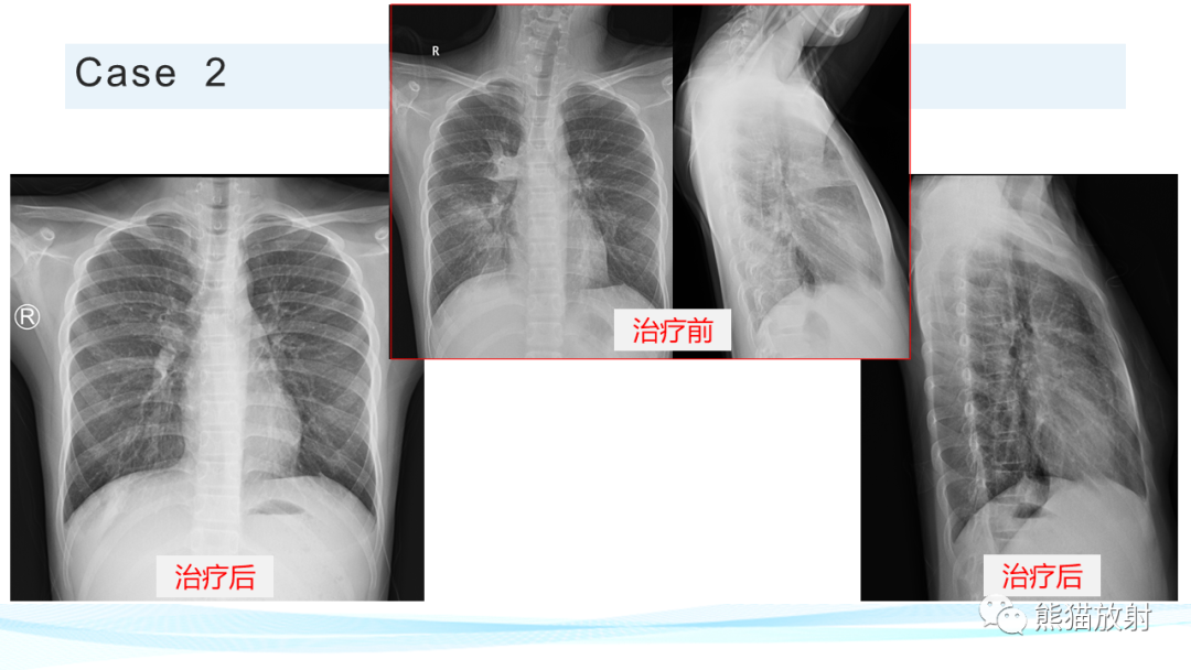影像PPT - 【PPT】肺炎的常见影像学表现-50