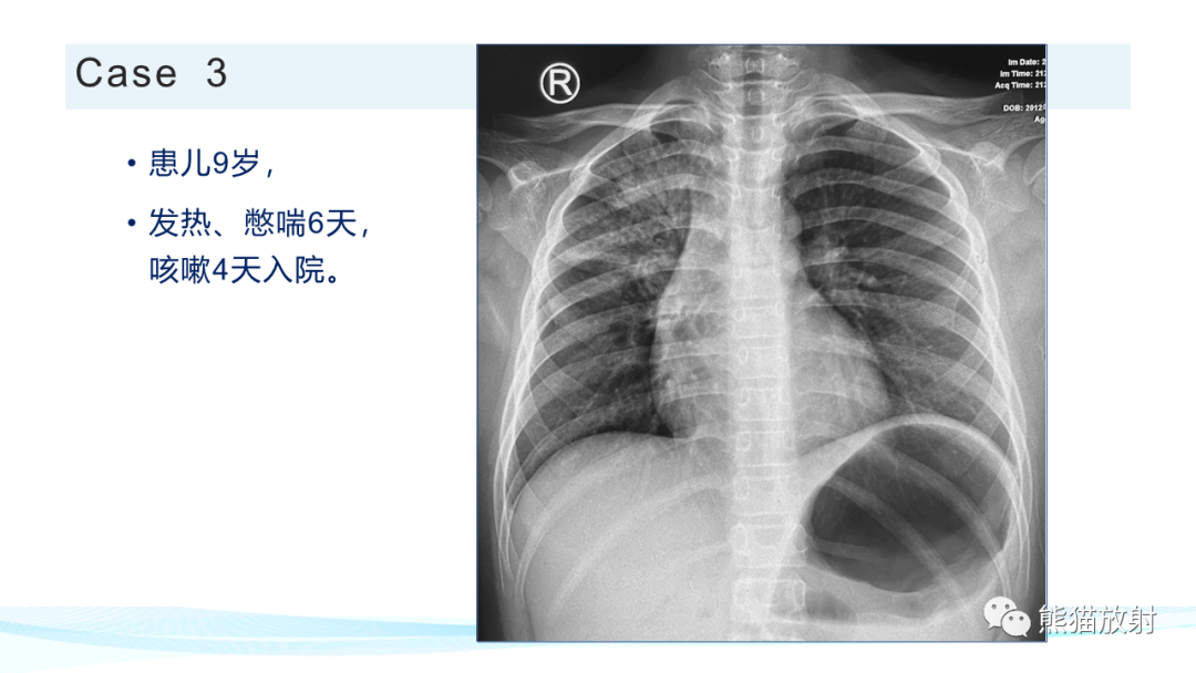 影像PPT - 【PPT】肺炎的常见影像学表现-52