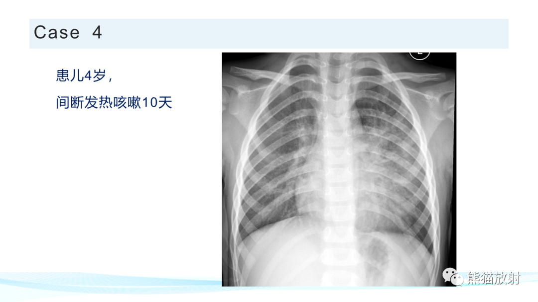 影像PPT - 【PPT】肺炎的常见影像学表现-57