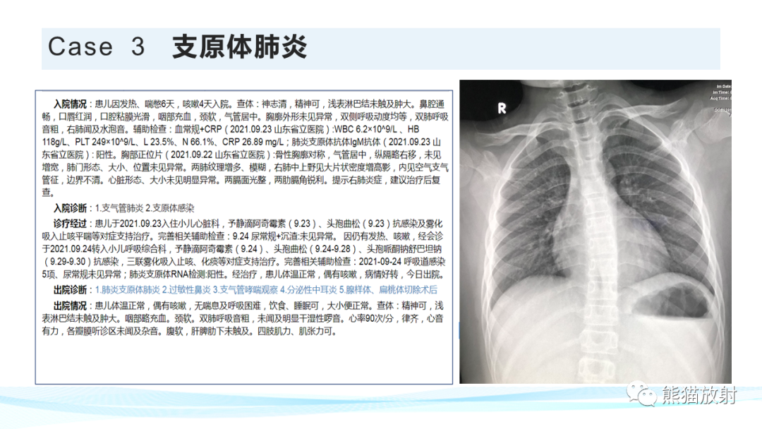 影像PPT - 【PPT】肺炎的常见影像学表现-55