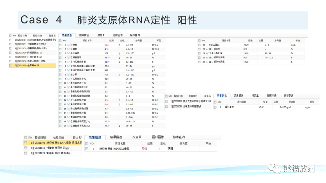 影像PPT - 【PPT】肺炎的常见影像学表现-59
