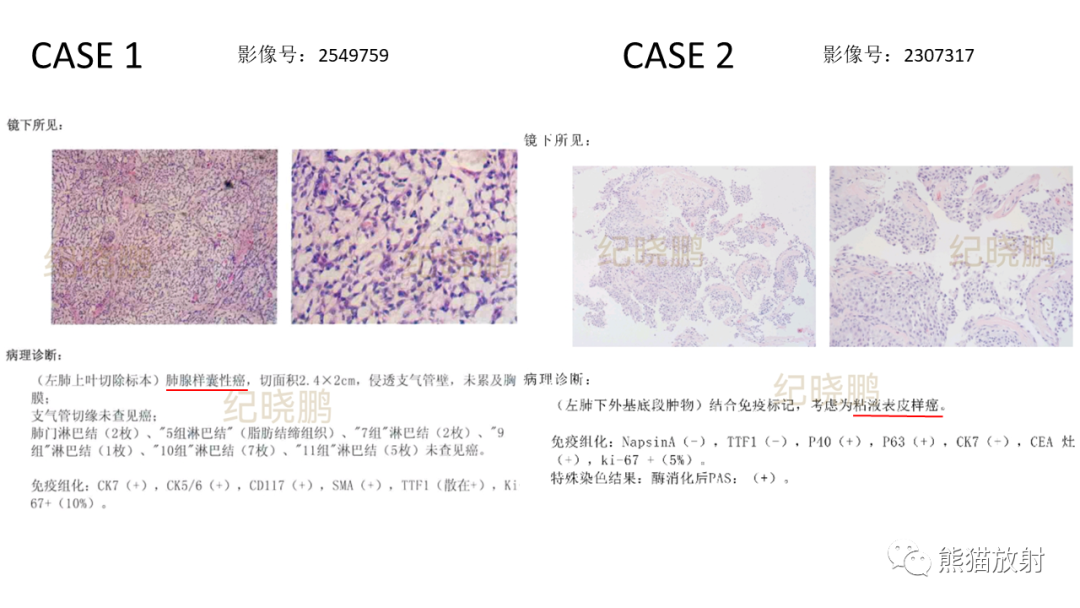 影像PPT - 【病例】肺腺样囊性癌 VS 粘液表皮样癌-23