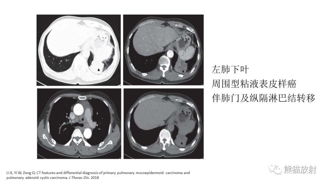 影像PPT - 【病例】肺腺样囊性癌 VS 粘液表皮样癌-32