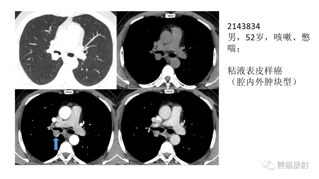 影像PPT - 【病例】肺腺样囊性癌 VS 粘液表皮样癌-30