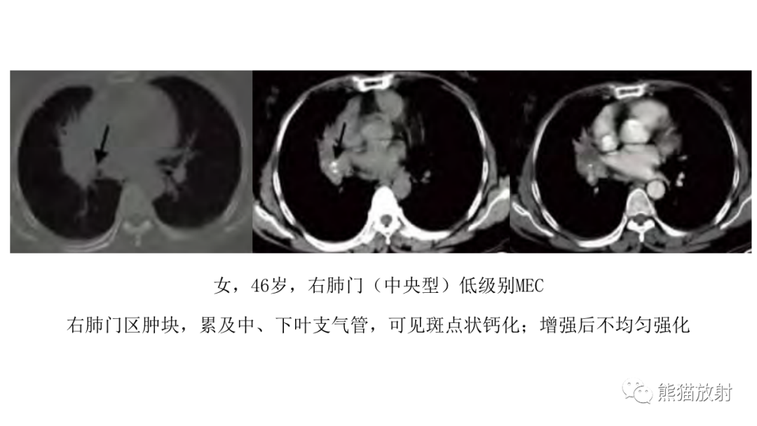 影像PPT - 【病例】肺腺样囊性癌 VS 粘液表皮样癌-31