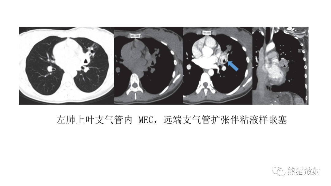 影像PPT - 【病例】肺腺样囊性癌 VS 粘液表皮样癌-33