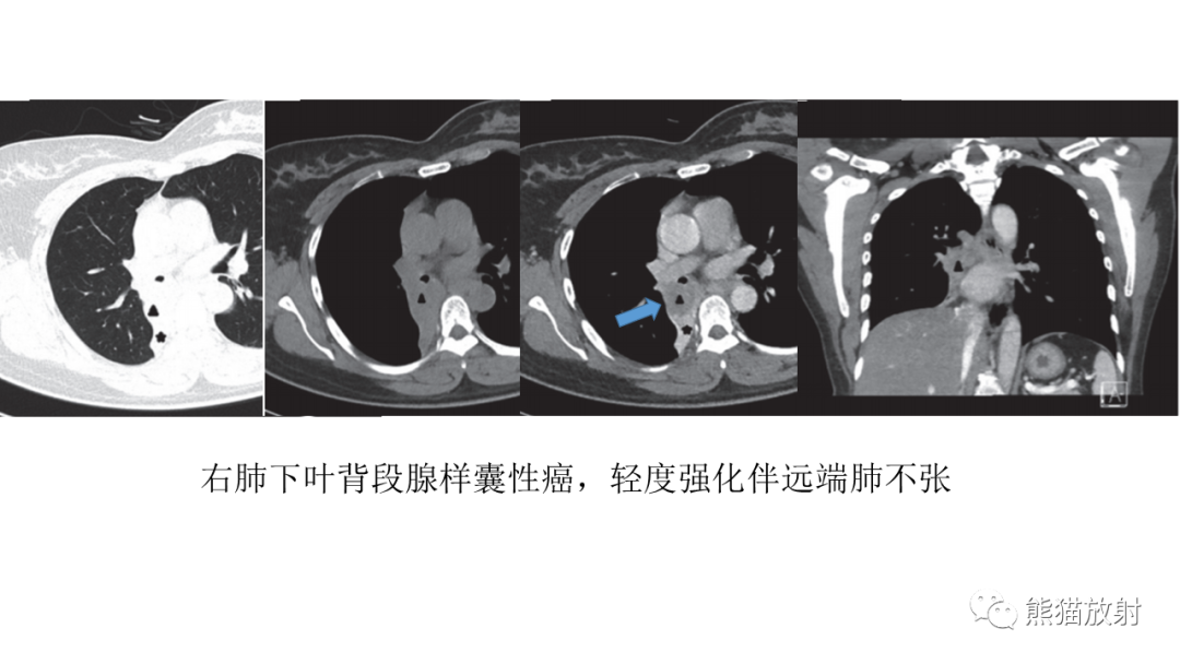 影像PPT - 【病例】肺腺样囊性癌 VS 粘液表皮样癌-37