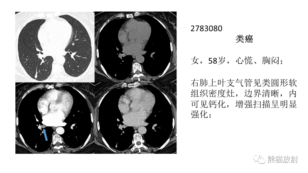 影像PPT - 【病例】肺腺样囊性癌 VS 粘液表皮样癌-39