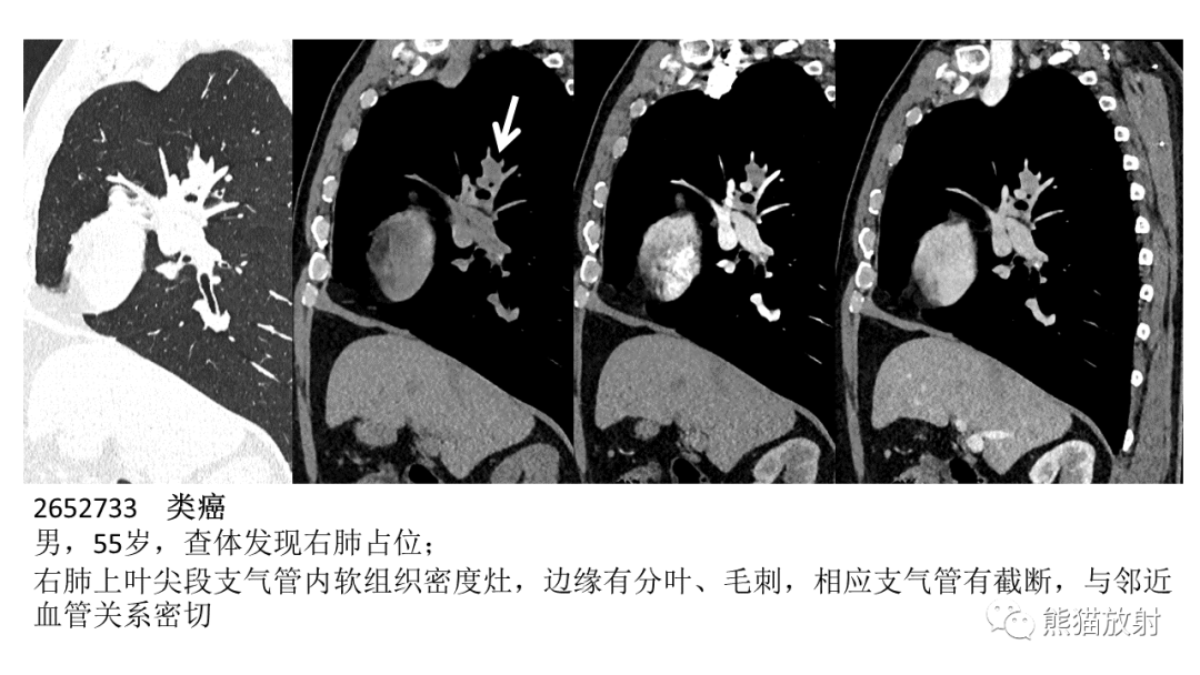 影像PPT - 【病例】肺腺样囊性癌 VS 粘液表皮样癌-40