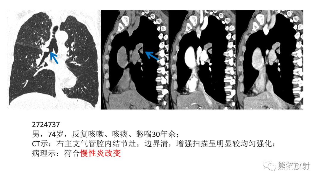 影像PPT - 【病例】肺腺样囊性癌 VS 粘液表皮样癌-42