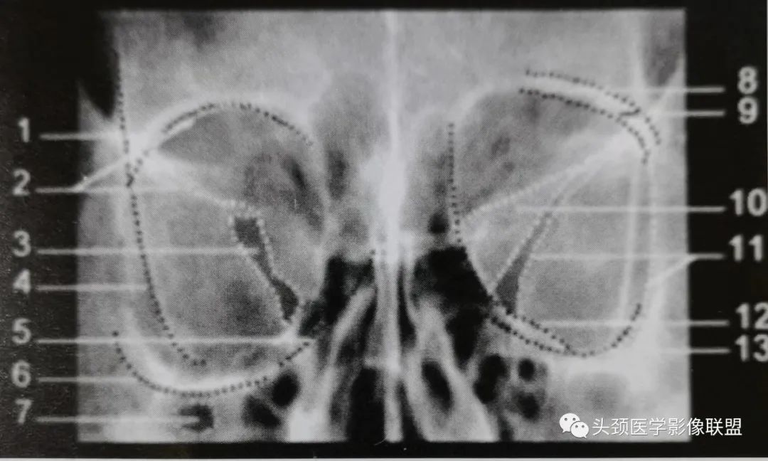 影像PPT - 眼眶解剖（X线/CT/MRI）和常见变异及误判-3