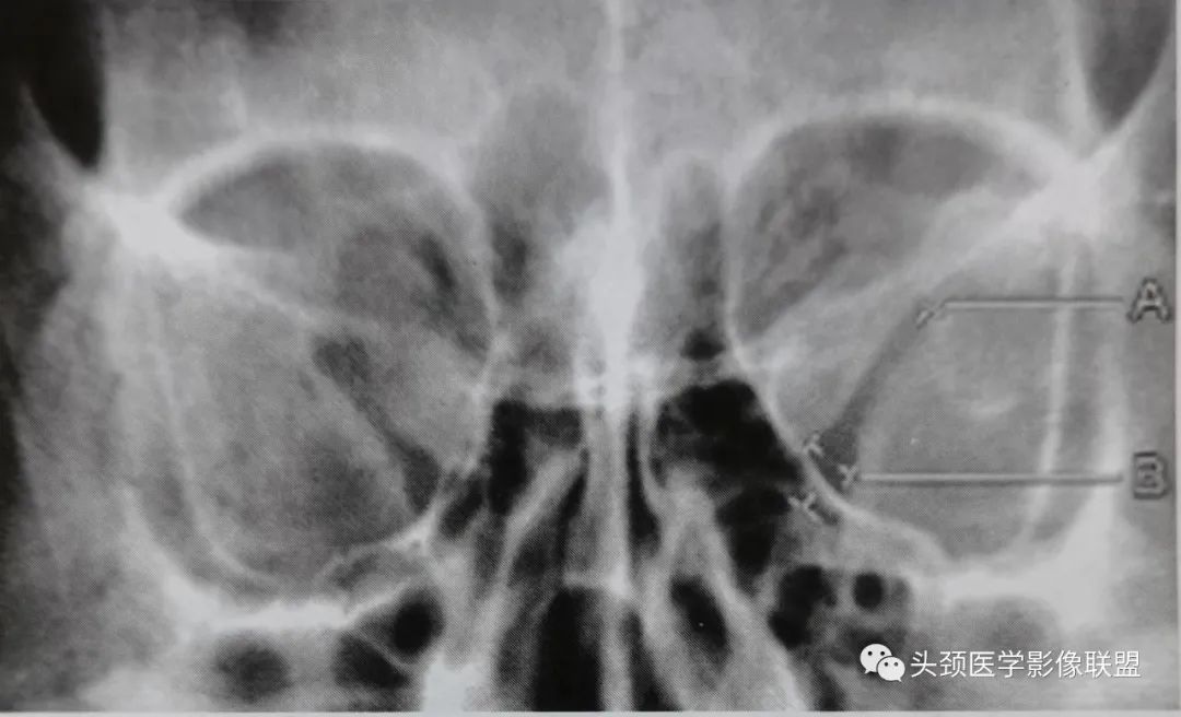 影像PPT - 眼眶解剖（X线/CT/MRI）和常见变异及误判-4