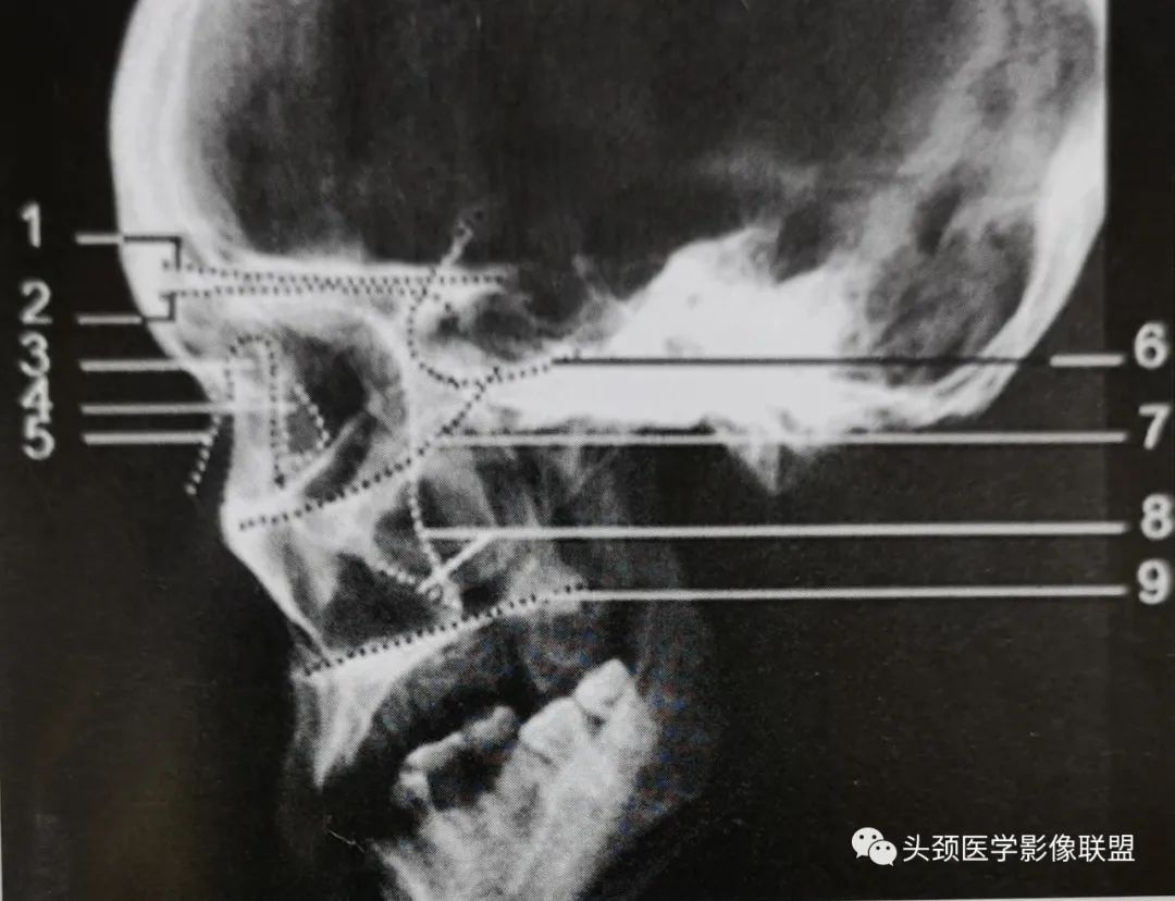 影像PPT - 眼眶解剖（X线/CT/MRI）和常见变异及误判-5